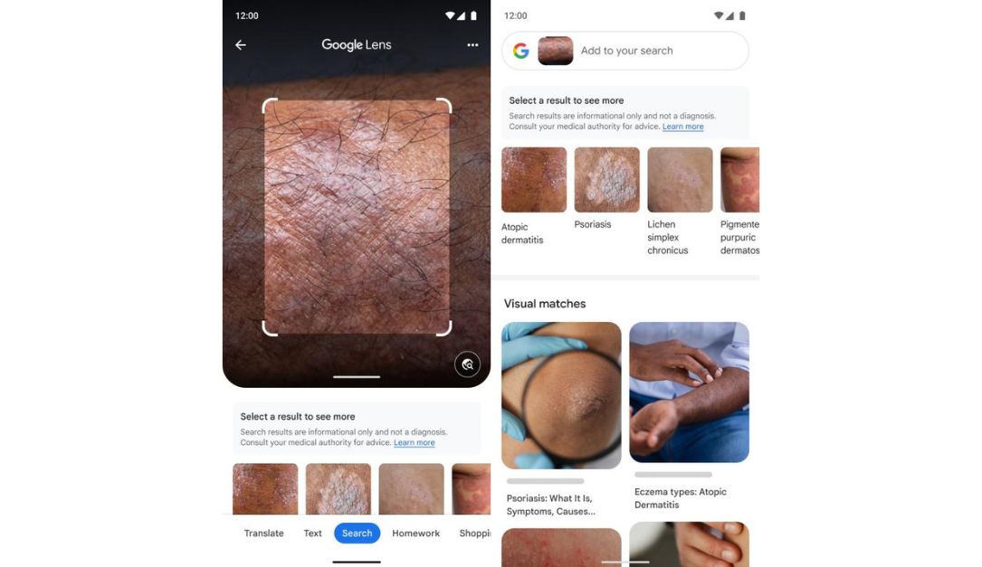 تطبيق جوجل Lens يستخدم الذكاء الاصطناعي للتعرّف على الأمراض الجلدية 1